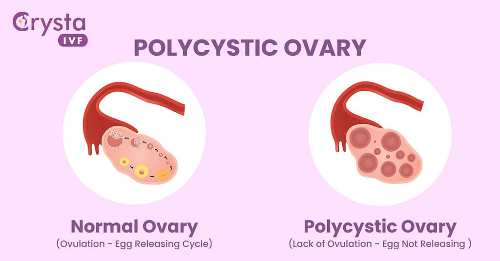 Ovarian Cysts and Pregnancy: Can A Cyst Stop You from Having a Baby? 2 Normal vs polycystic ovary
